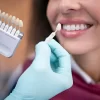 Carillas dentales estéticas en Exident Clinic para mejorar la sonrisa