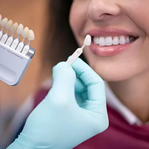 Carillas dentales estéticas en Exident Clinic para mejorar la sonrisa