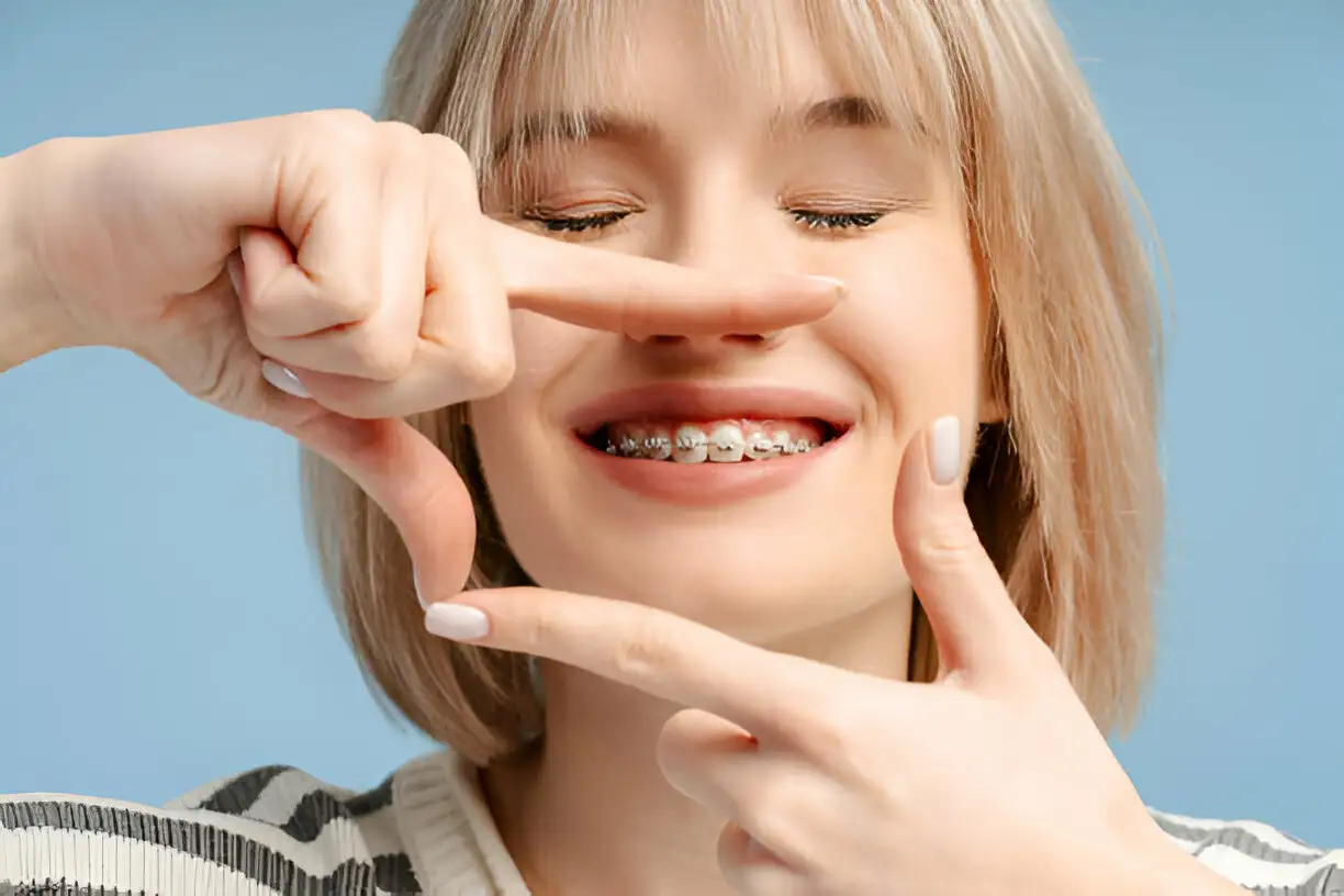 Instalación de brackets en Exident Clinic para corregir la alineación dental