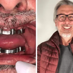 🦷 Oferta Implantes Dentales en Santiago Centro