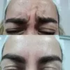 Botox en la frente